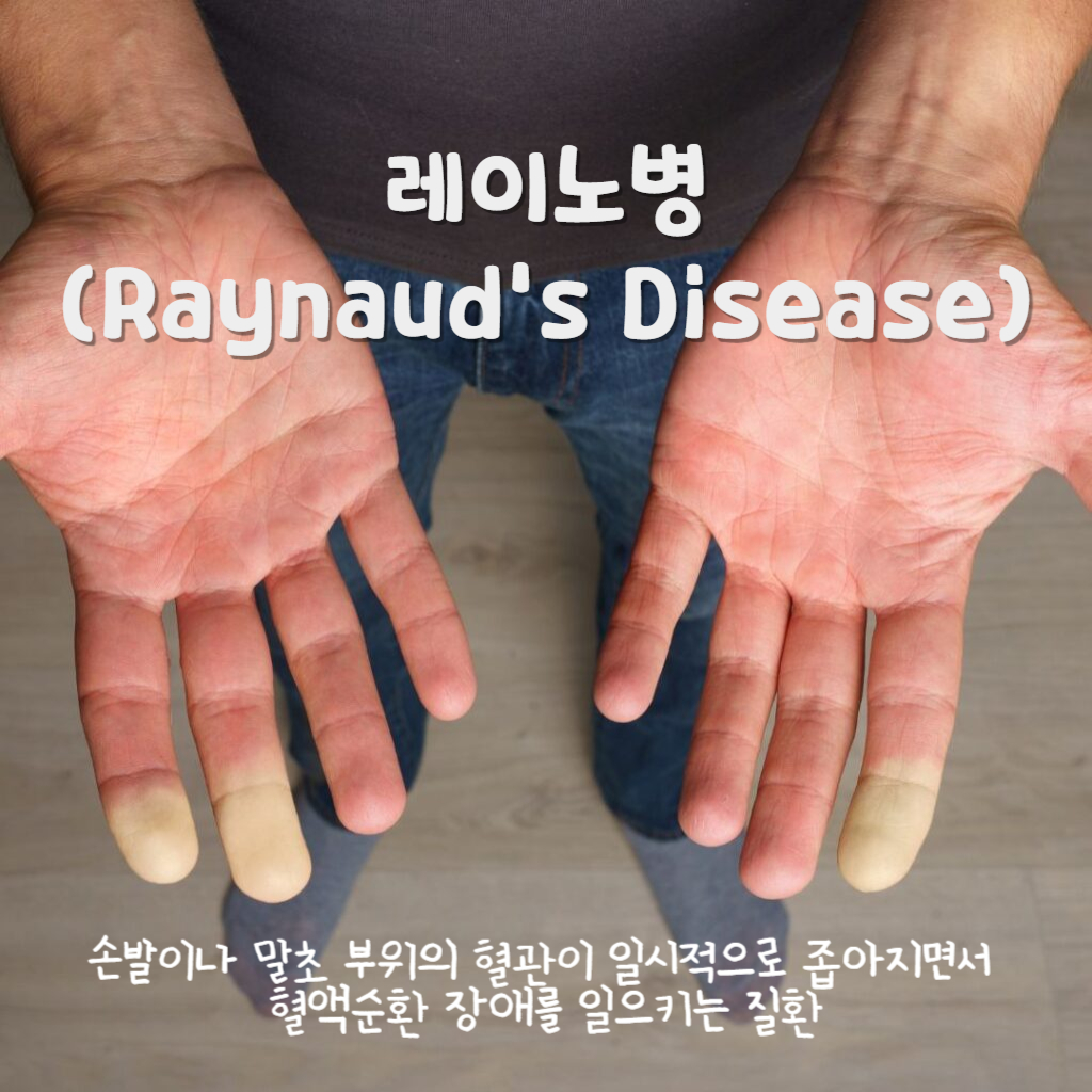 레이노병(Raynaud's Disease)
레이노병은 손발이나 말초 부위의 혈관이 일시적으로 좁아지면서 혈액순환 장애를 일으키는 질환.