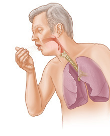 만성 기관지염(Chronic Bronchitis) 간호