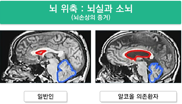 알코올로-인한-뇌손상 (출처: 국립부곡병원, KBS 생로병사의 비밀)