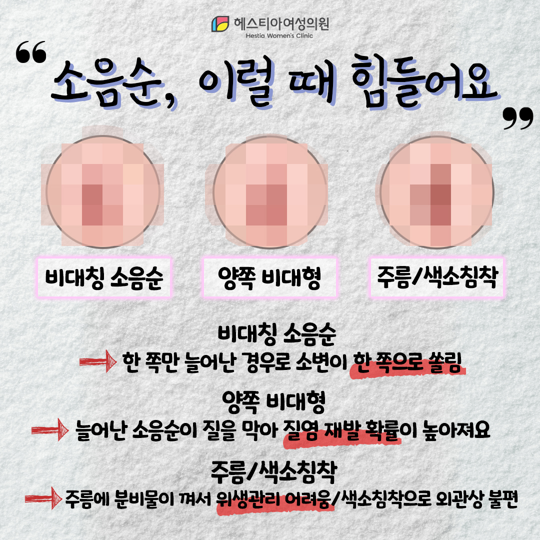 언주역산부인과 소음순비대증 원인 질염 재발 다양한 소음순 불편점