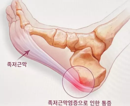 족저근막염 초기에 대처해야 하는 이유와 대처방법