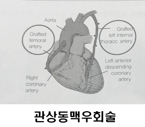 관상동맥우회술