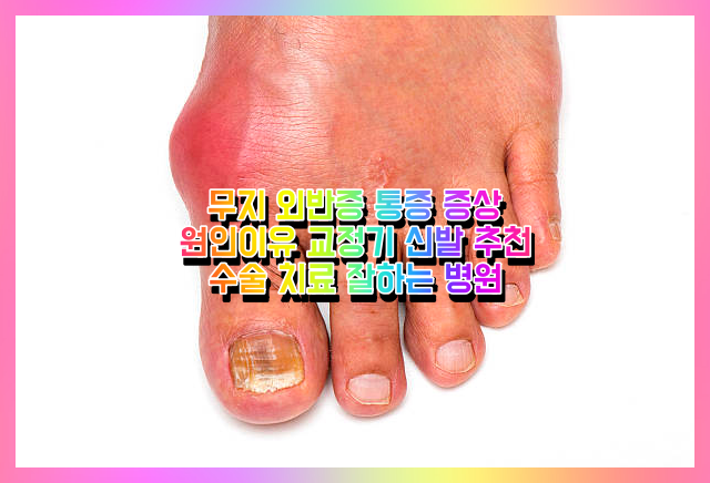  무지 외반증 엄지발가락 통증 증상 원인이유 교정기 신발 추천 수술 치료 잘하는 병원 (깔창, 신발, 수술종류, 영어, 무지외반증 엄지발가락 각도 단계 증상)