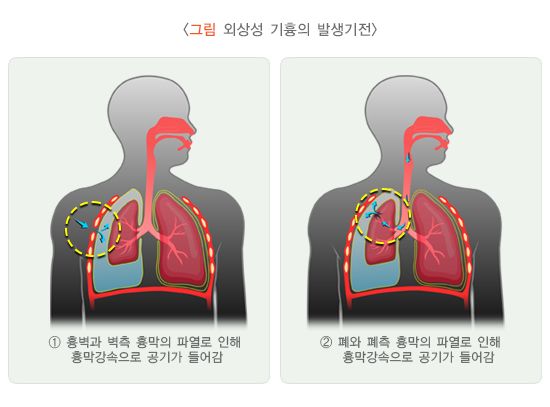 외상성기흉