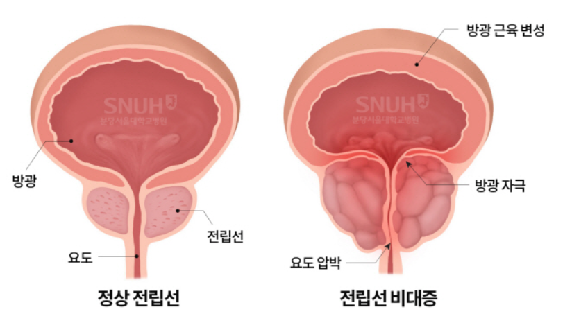 전립선