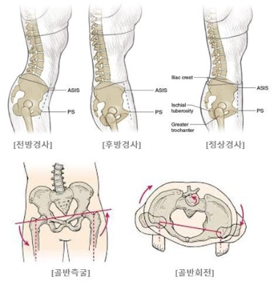 골반비대칭