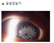 아벨리노각막증-동형접합자-눈-사진