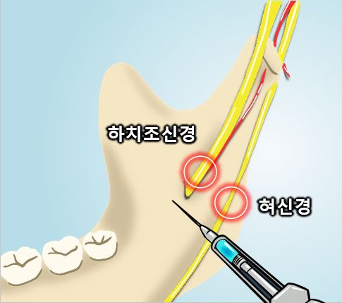 치과 마취주사 부작용, 신경손상 증세, 구강내과 치과의사가 다 알려드림