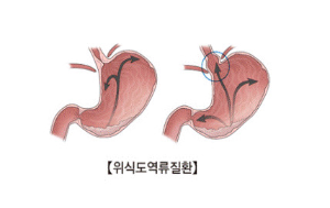 위에서 역류하는 모습