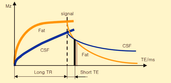  Proton density 강조영상 (PD weighted image)