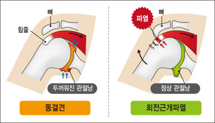  오십견, 삼십견으로 바뀔 수도 있다! 예방하는 습관은?
