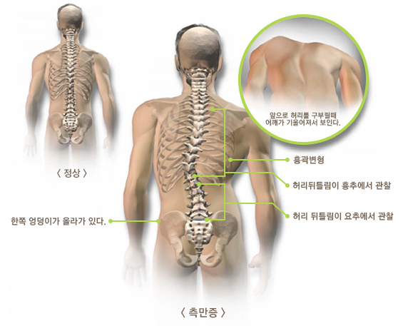 척추측만증