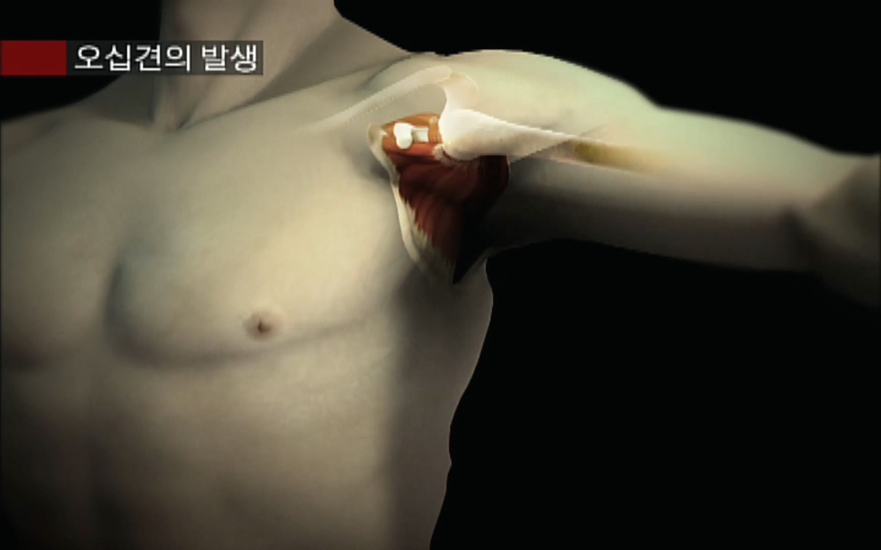 EBS 명의 헬스케어 - TV - 교육의 중심 EBS50대의 공포, 오십견 - 재활의학과 전문의 이강우 교수.mp4_20220913_202315.186.jpg