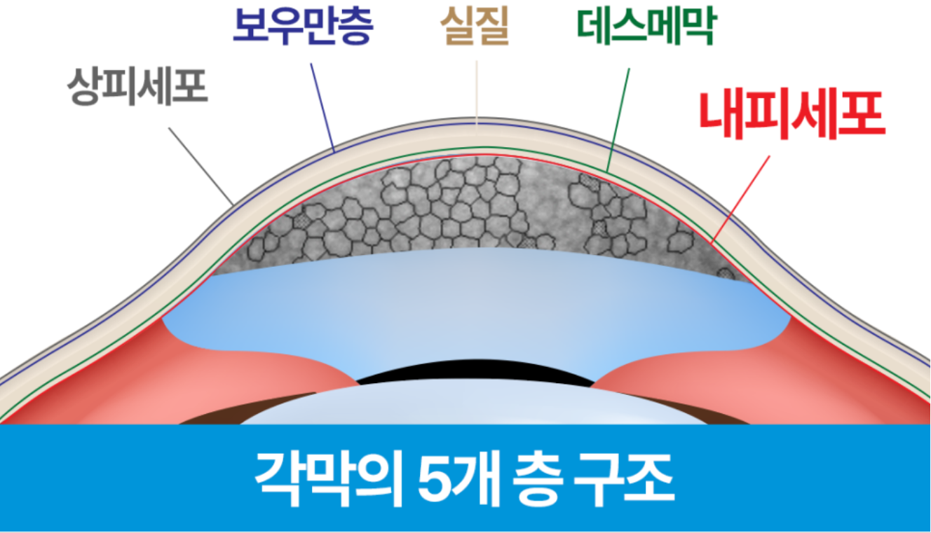 라식 상담했는데 각막내피 세포수가 낮아서 안된대요...