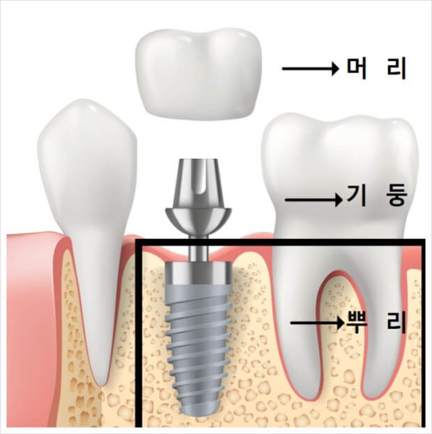 임플란트 장점