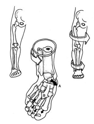 발의 아치의 무너짐과 발의 내회전을 나타내는 그림
