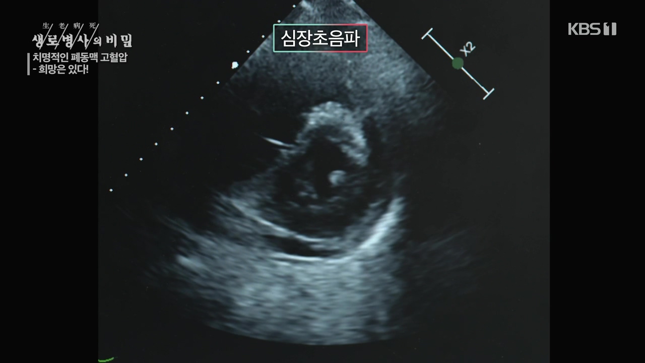 생로병사의 비밀.E900.240215p-NEXT.mp4_20240215_201744.262.jpg