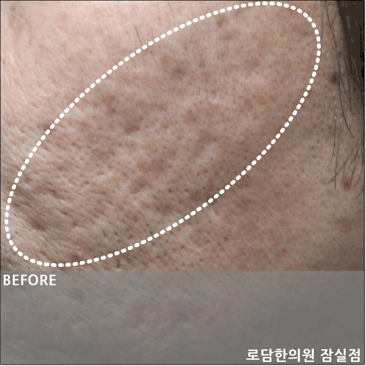  여드름흉터피부과 아닌 한의원 패인 흉터 치료 새살침 코라테라피로