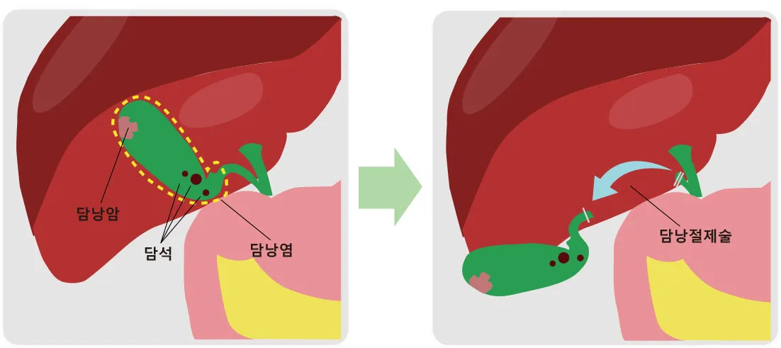 담낭 제거 수술후 먹지말아야할 음식