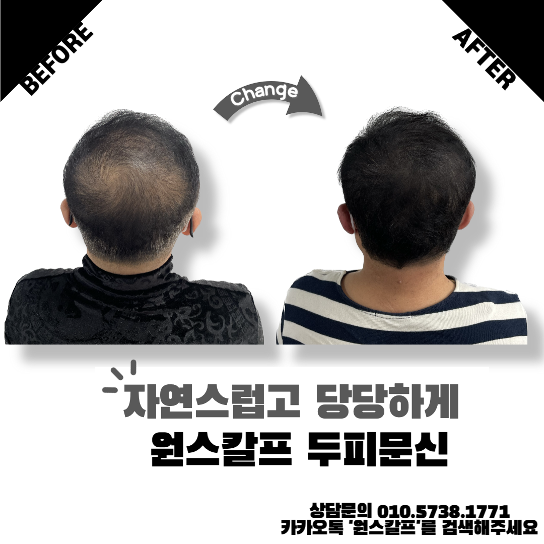  부산두피문신, 압도적 1위 원스칼프에서 시술과 교육받는법!
