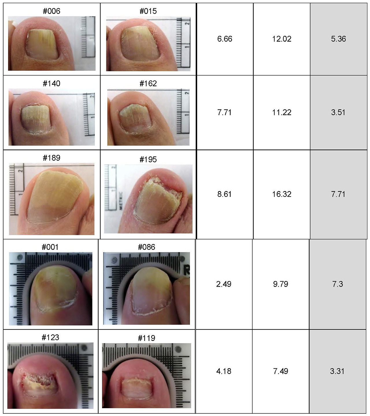 발톱무좀-레이저-치료-루눌라레이저