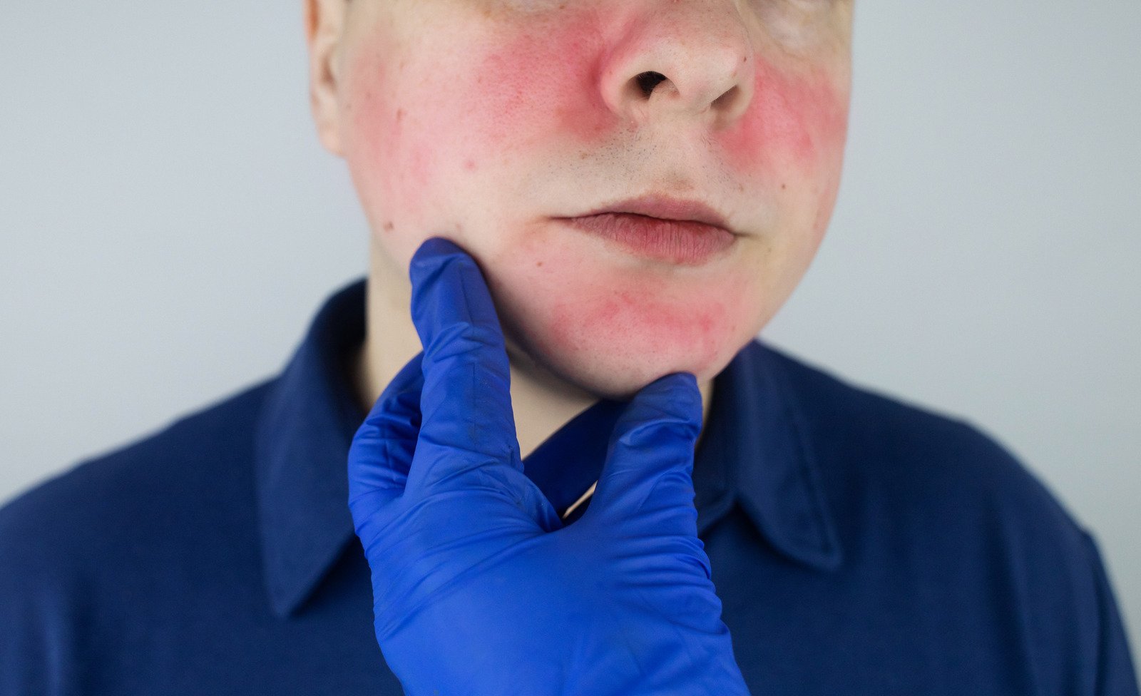 주사(Rosacea): 만성 염증성 피부질환