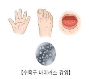 수족구증상-원인-치료방법