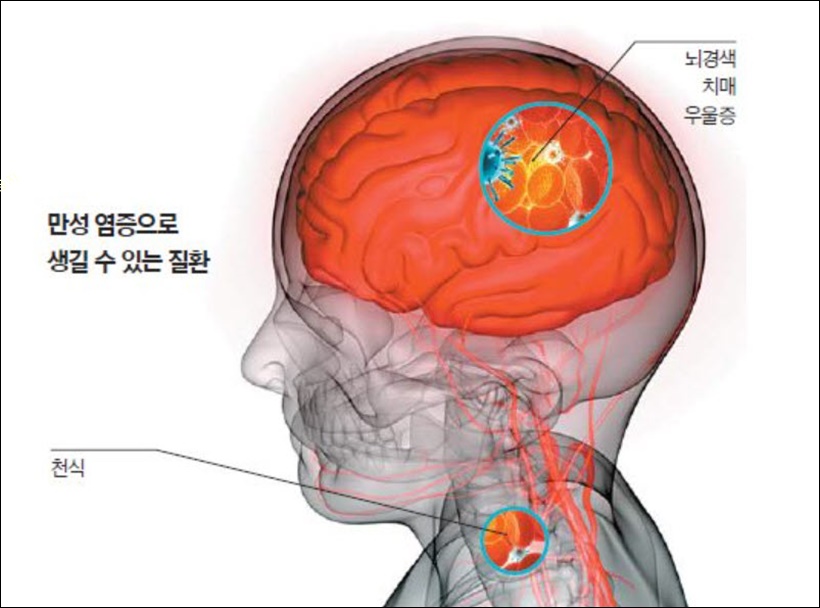 염증 치매 위험