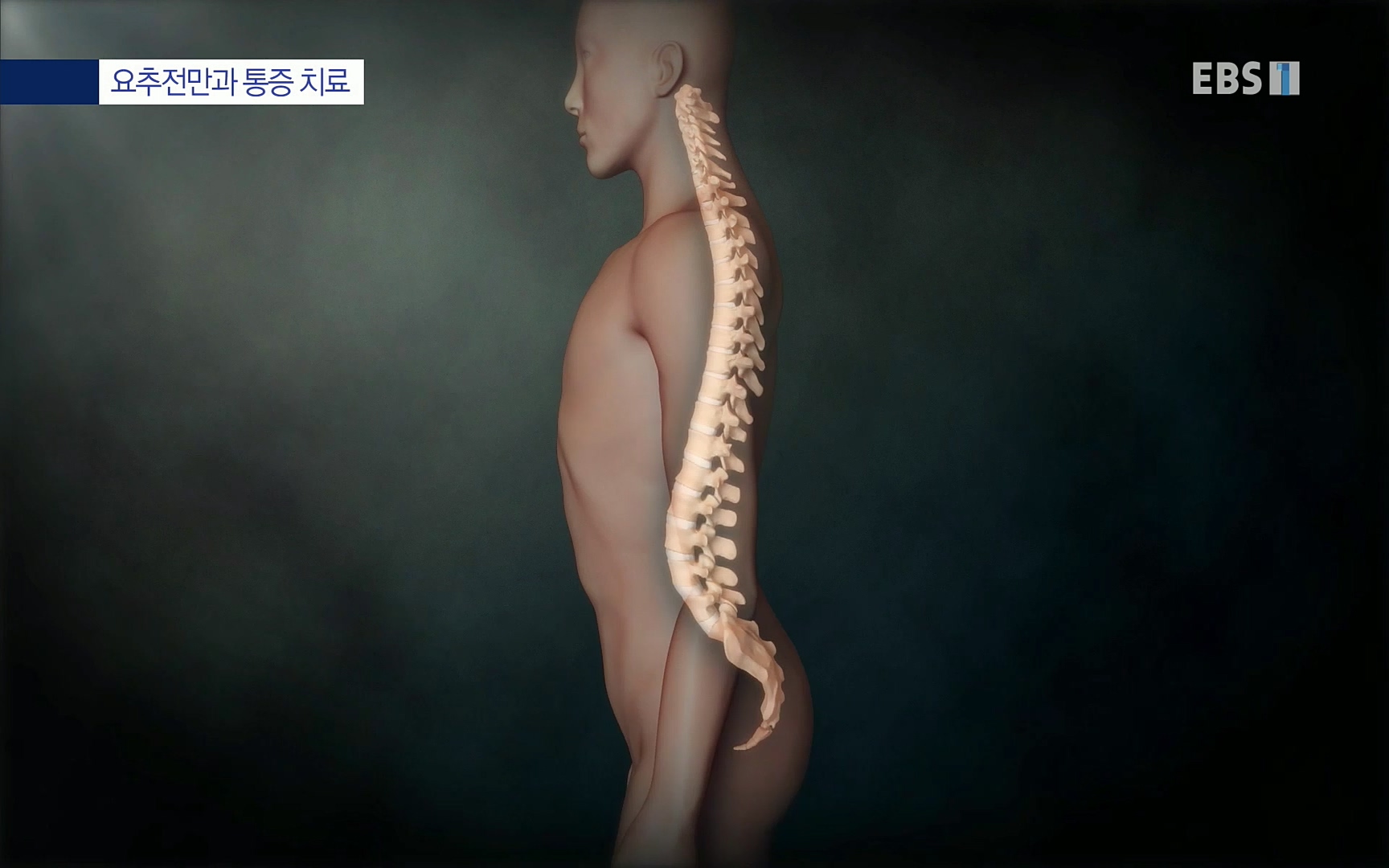 EBS 명의 헬스케어 - TV - 교육의 중심 EBS허리 통증 치료 프로젝트 1부, 수술없이 낫는다 .mp4_20220712_204235.306.jpg