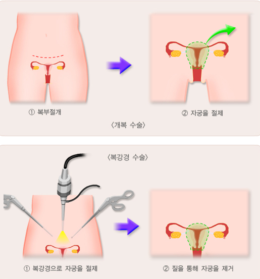 자궁근종수술의종류