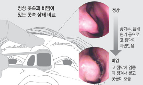 비염 상태