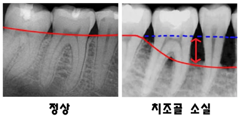 치조골 소실 모습 X-ray 사진