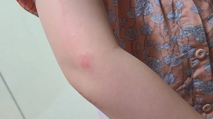  모기 물렸는데 연조직염(봉와직염) 여름철 더 주의하기