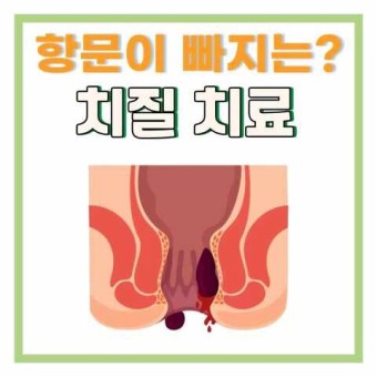  치질 원인과 증세 증상 수술 관리법