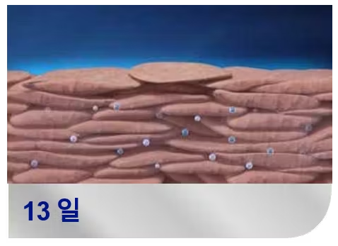 각질층에-잔존한-테르비나핀
