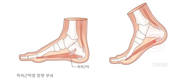 족저근막염