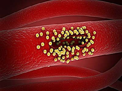 염증 수치 낮추는 방법 10가지