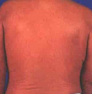 홍피성 건선 (erythrodermic psoriasis)