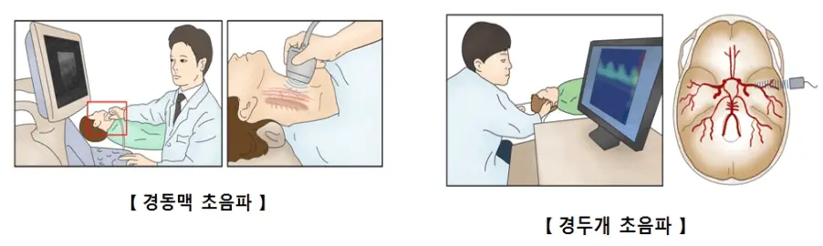 동맥경화증 진단 방법 (출처 : 서울아산병원 건강정보)