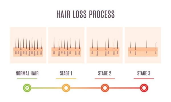 탈모 과정