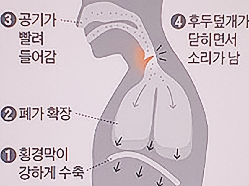 딸꾹질-원리