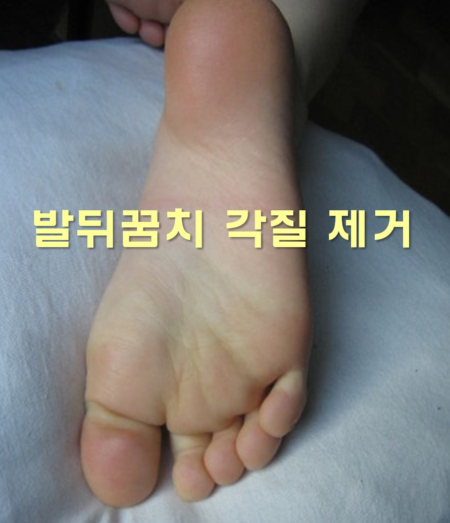  발뒤꿈치 각질 제거 시 올리브영 발각질 제거팩 추천 제품