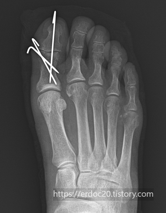 엄지 발가락 골절부위 핀 고정술 시행 후 x-ray 사진