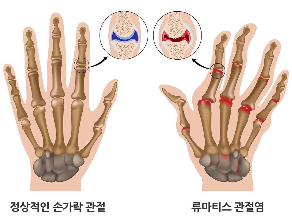 류마티스 관절염