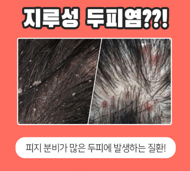 두피 지루성 피부염 치료 병원과 원인