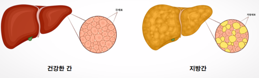 지방간, 간경화, 간질환, 감염