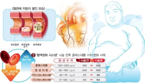 중성지방 낮추는 방법