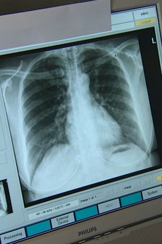 충격! 세계 첫 사람 폐에서 미세 플라스틱 발견 VIDEO:Microplastics found deep in lungs of living people for first time