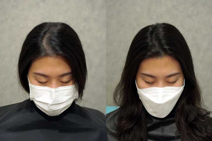 앞머리 가르마 탈모를 두피문신으로 시술한 전후 사진