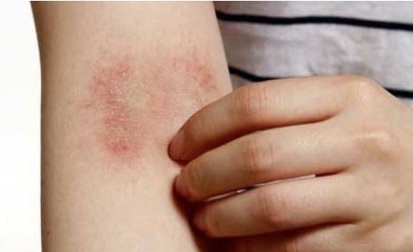  아토피에 좋은음식